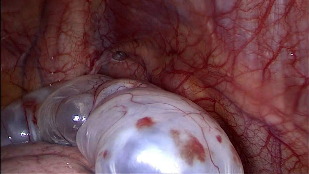 ثلاثة أكياس في الفص العلوي للرئة اليمنى-عملية جراحة الصدر