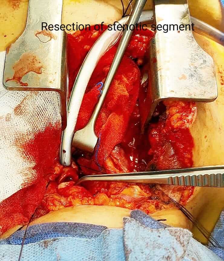 استئصال الجزء الضيق-عملية جراحة صدر