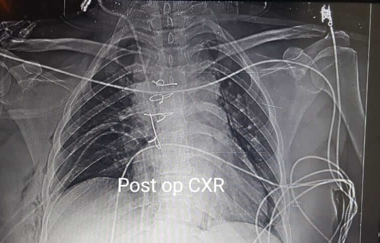 أشعة ما بعد العملية/عملية جراحة الصدر